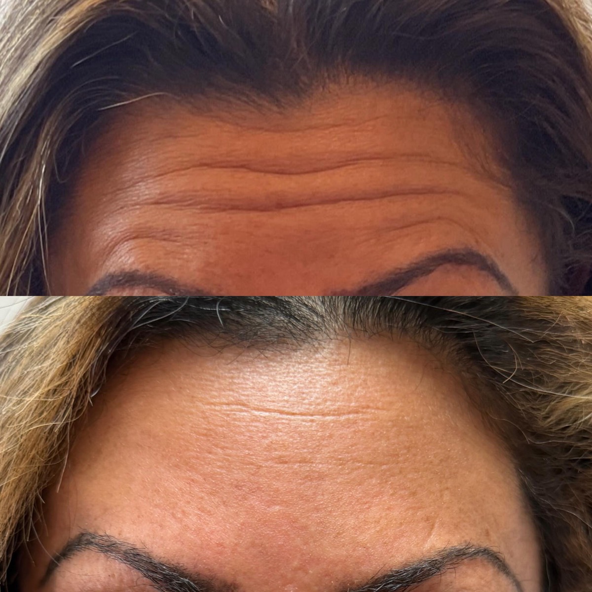 Botox before and after — forehead lines visibly softened, by Nada Hannawi, DNP in Ridgewood, NJ