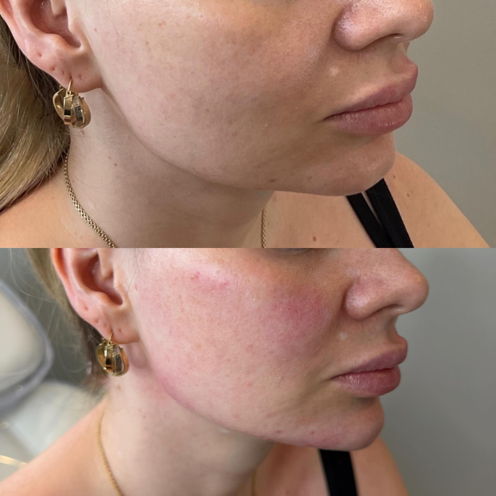 Facial balancing before and after — subtle profile refinement by Nada Hannawi, DNP