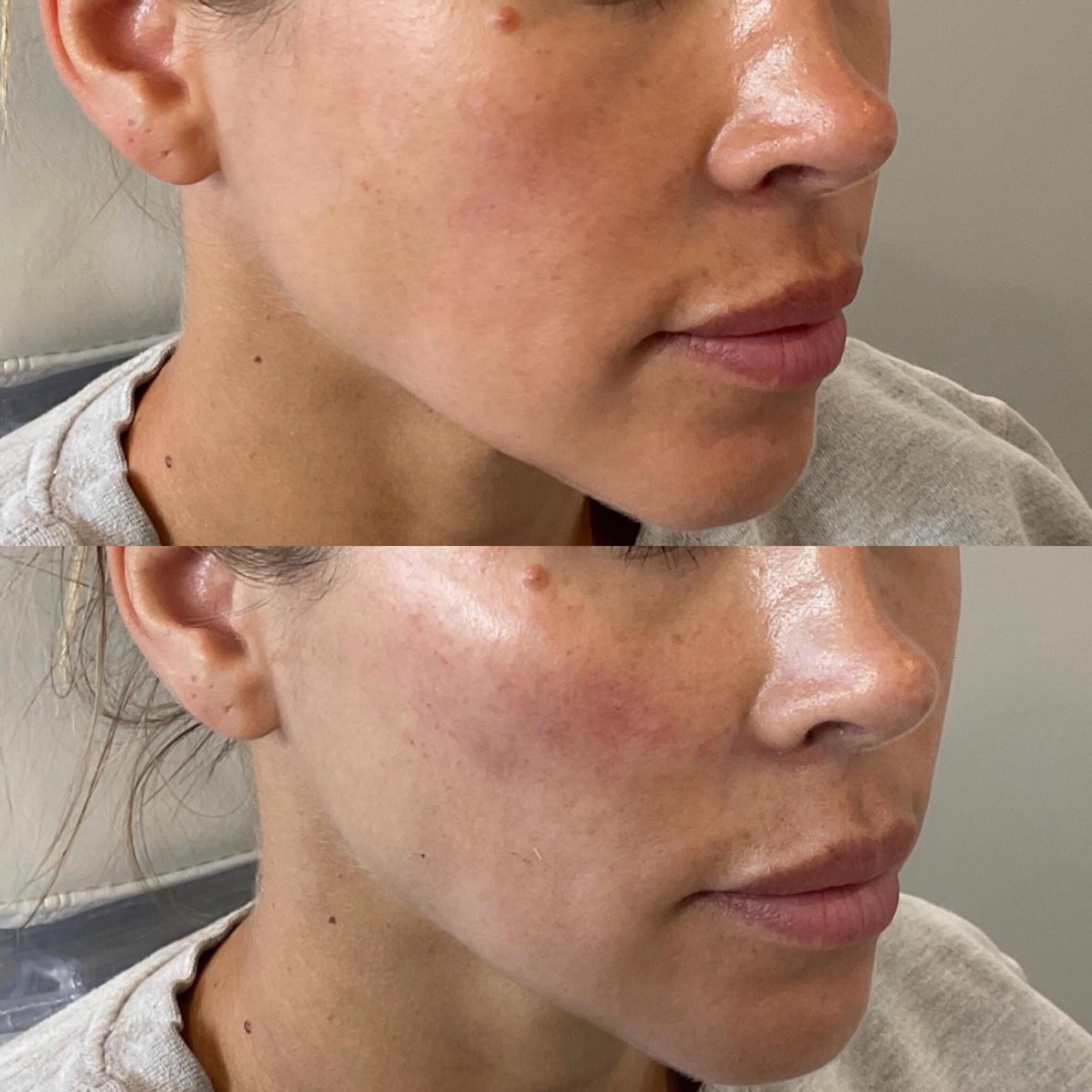Biostimulator before and after — lifted, contoured jawline and cheek