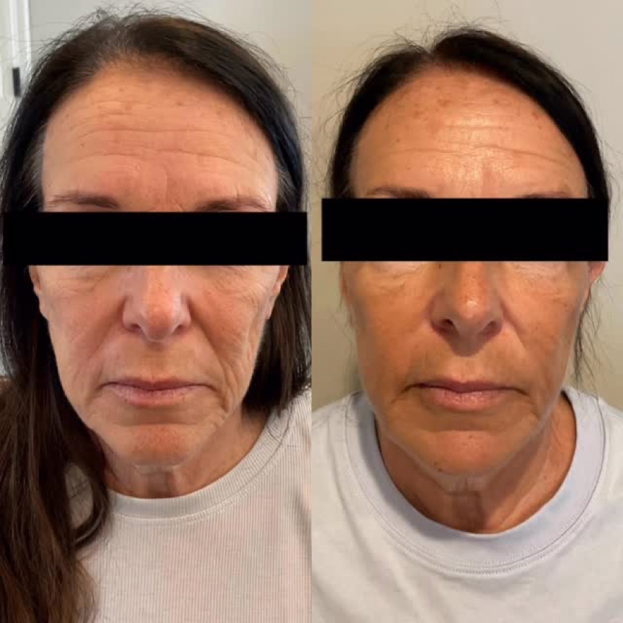 Facial rejuvenation progress over two months at Aesthetics by Nada