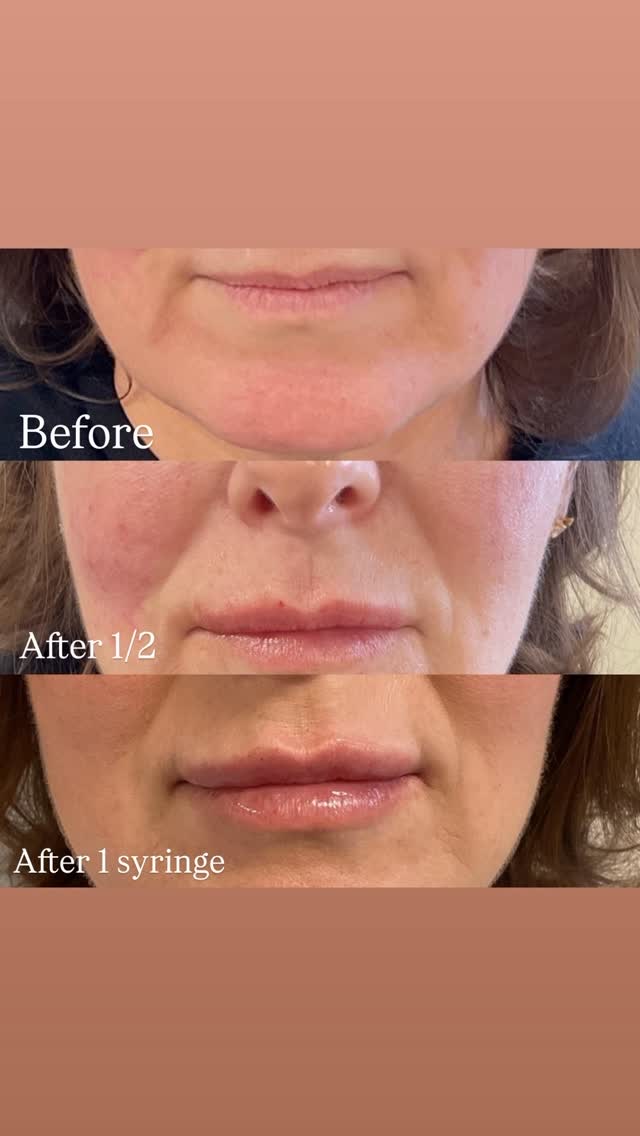 Natural lip filler progression before and after at Aesthetics by Nada